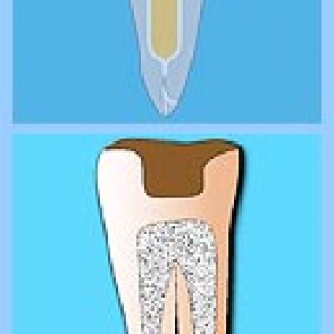 Микропротезирование в стоматологии