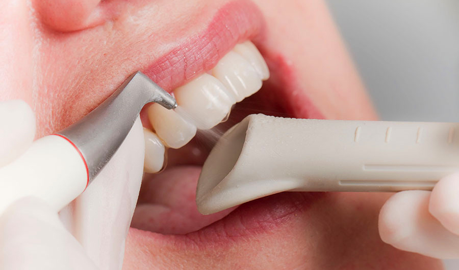 Удаление зубного камня в стоматологии