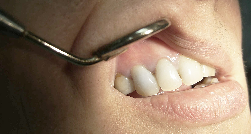 Удаление кисты зуба