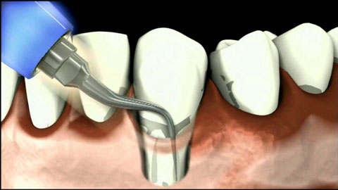 Лечение пародонтита в стоматологических клиниках «ТАВИ» и «Вероника»