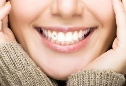 Установка зубных украшений в стоматологических клиниках «ТАВИ» и «Вероника»