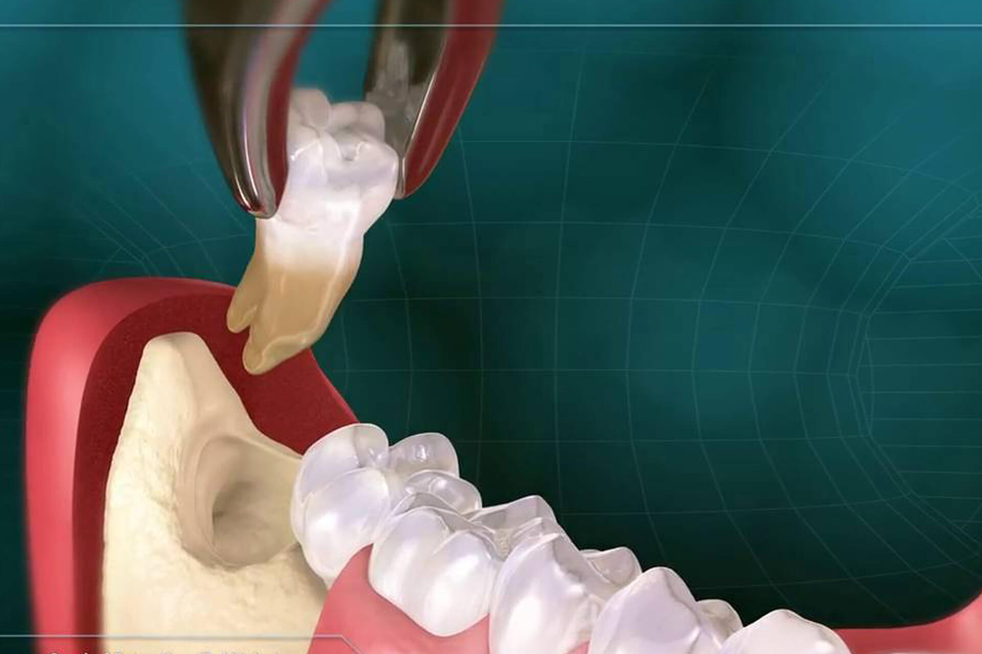 Альвеолит стоматология
