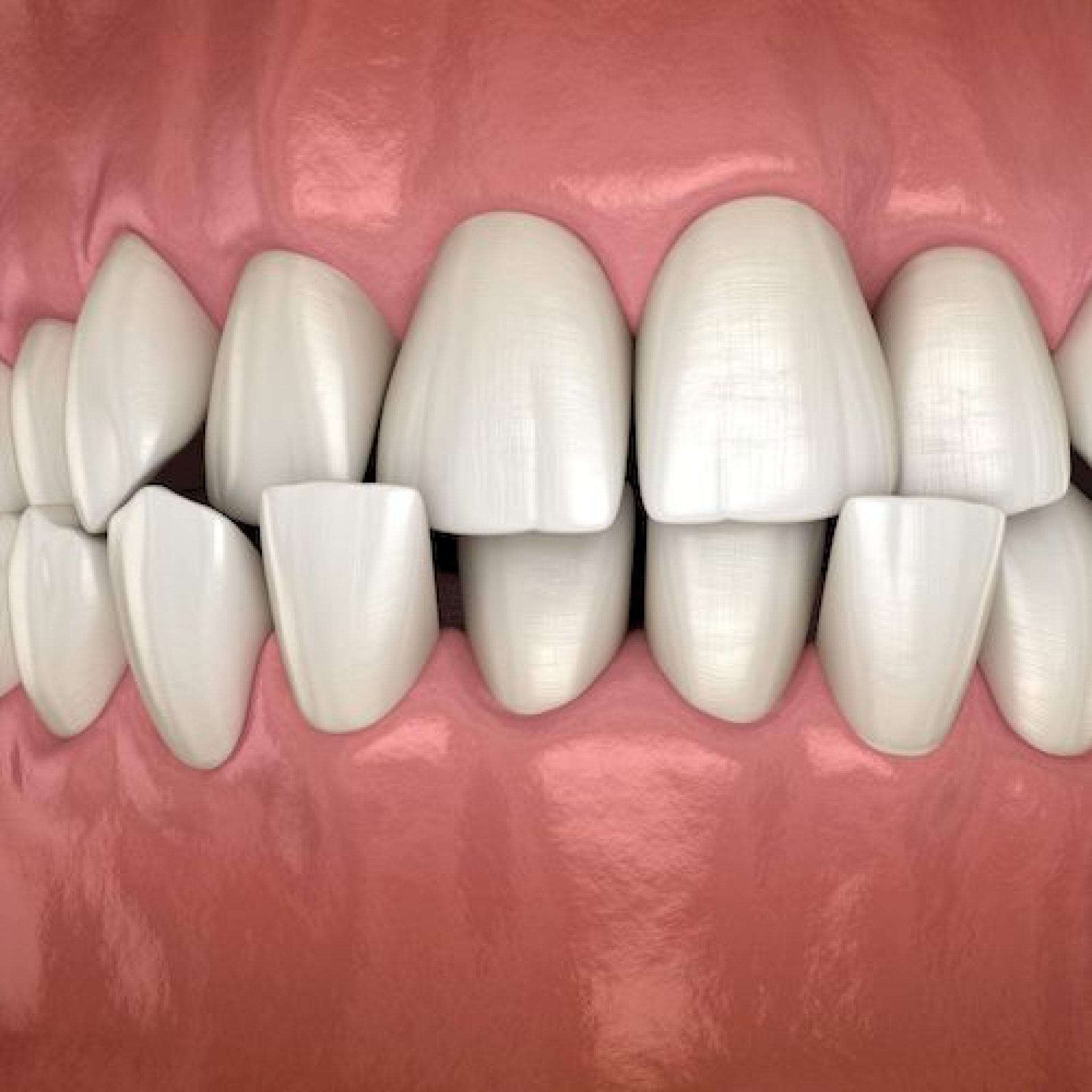 фото исправленных зубов