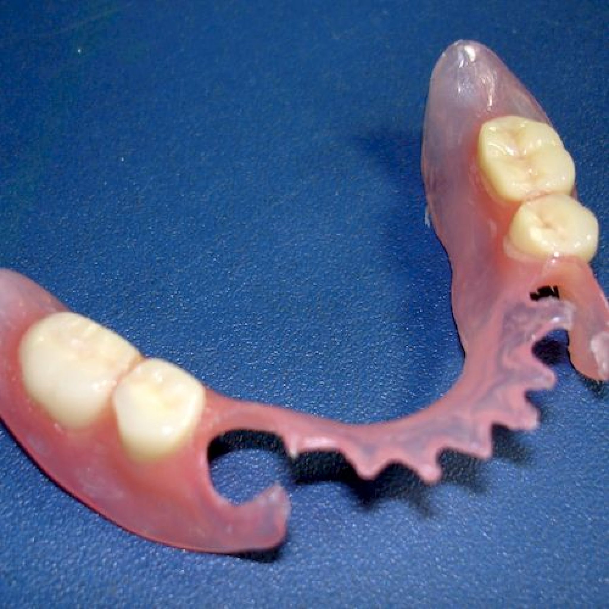 Протез на челюсть без зубов. Нейлоновый микропротез 1-3 зуба. Микропротез Квадротти. Съёмный нейлоновый протезз. Пластинчатый микропротез.